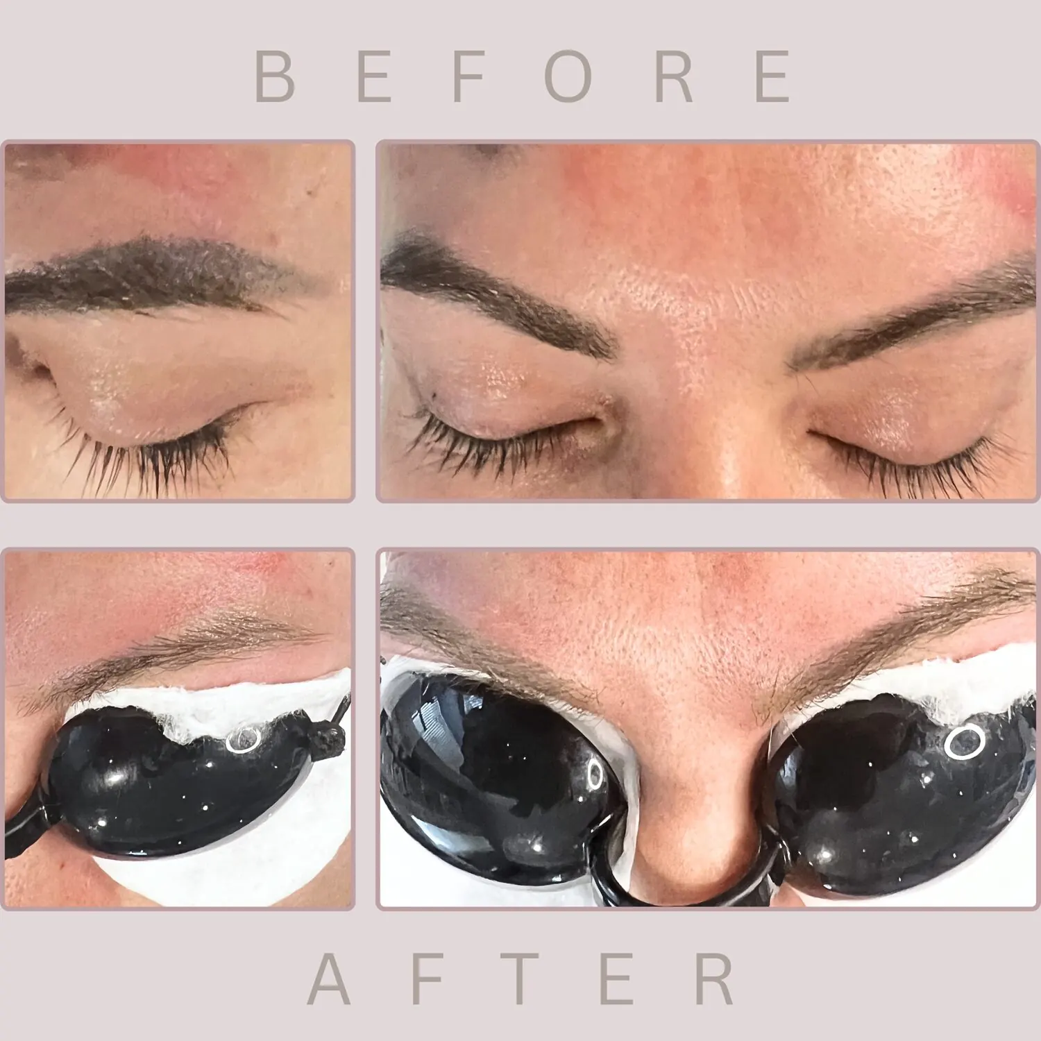 Eyebrow tattoo before treatment, and after with eye shields on
