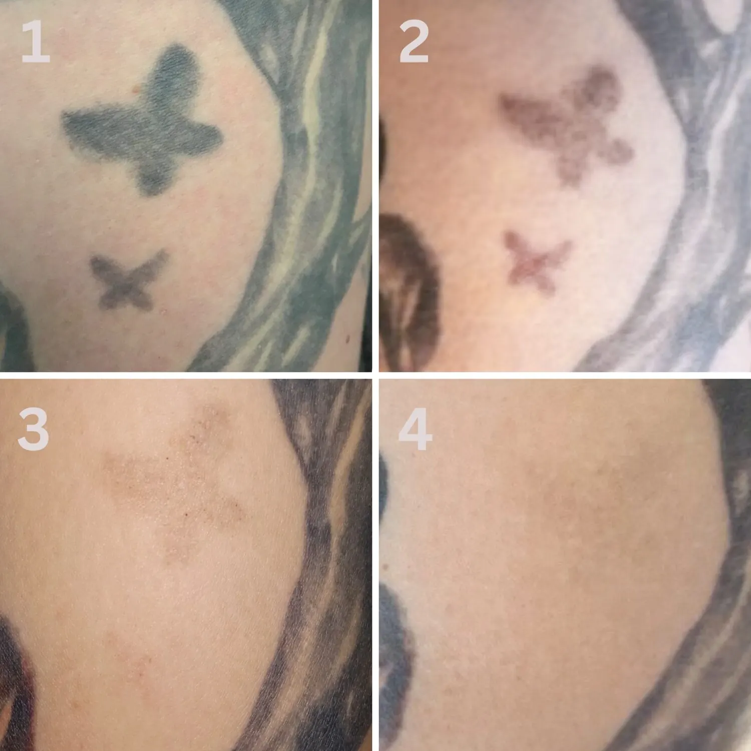 Butterfly tattoo fading across four sessions