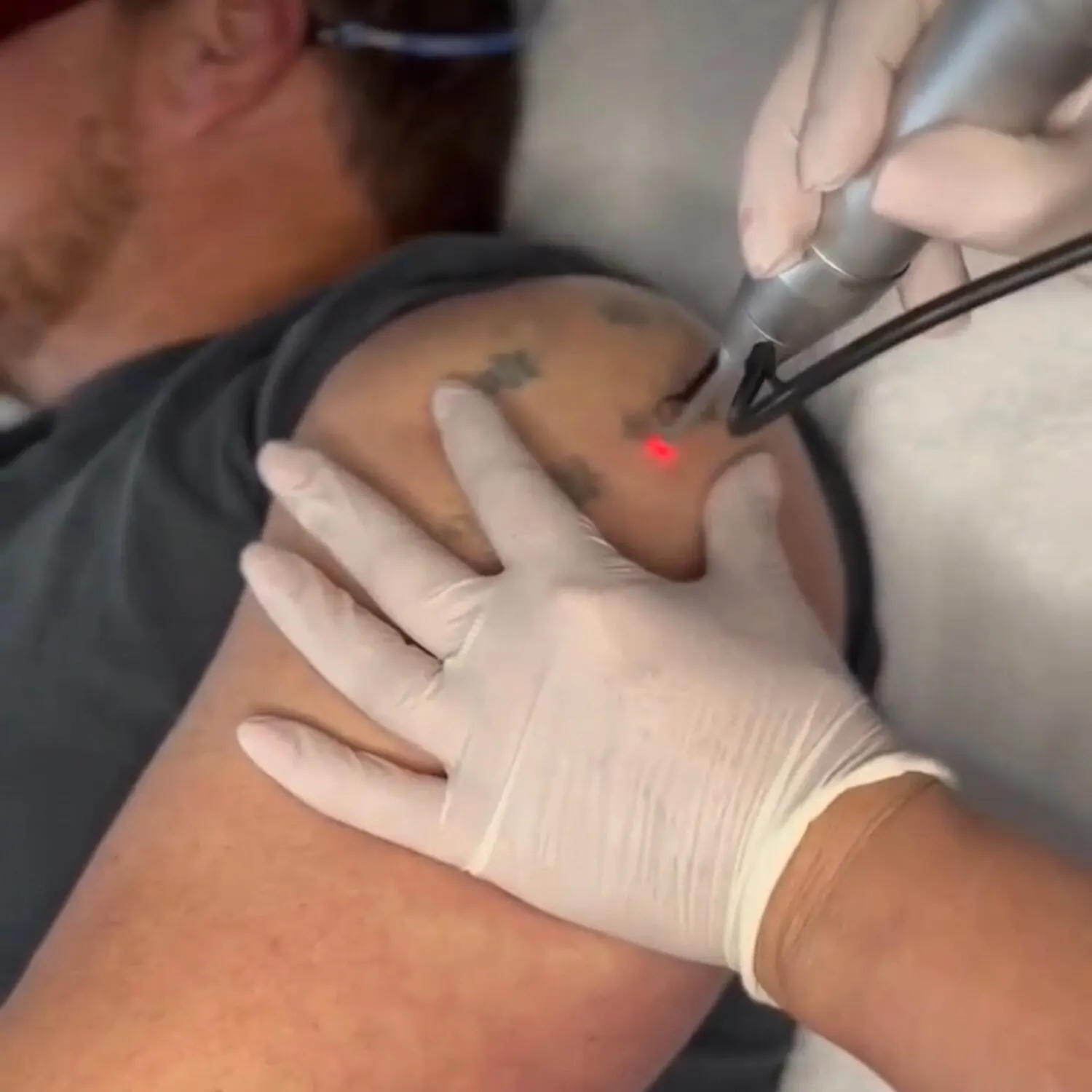 Laser handpiece on a shoulder tattoo